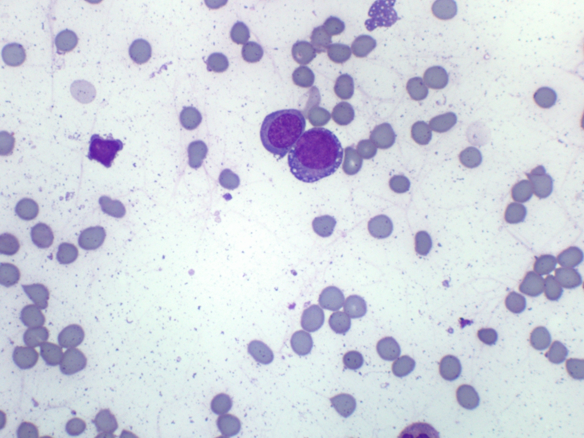 Aspirate smear showing vacoules in the RBC precursors